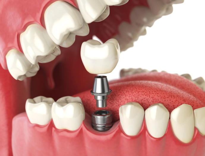 implantes dentales en Hospitalet de Llobregat