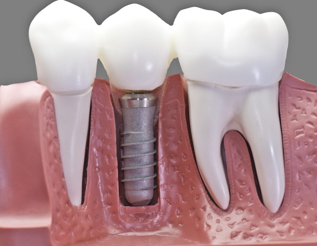 implantologia-protesisdental-04